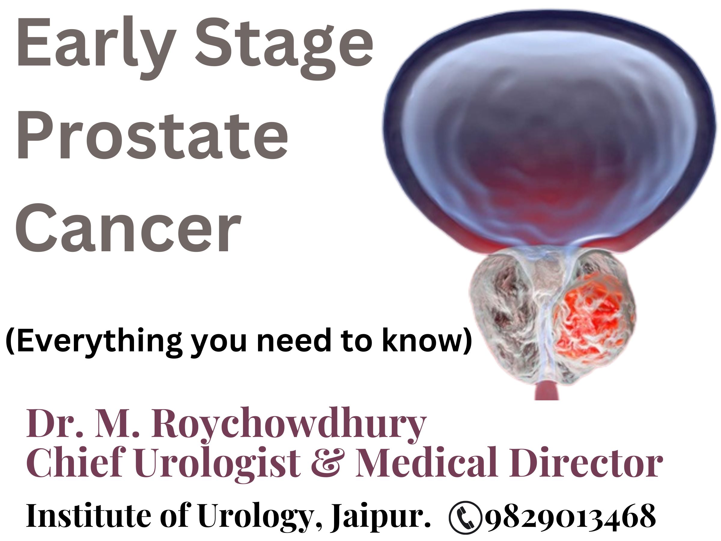 Radiotherapy For Prostate Cancer Institute Of Urology