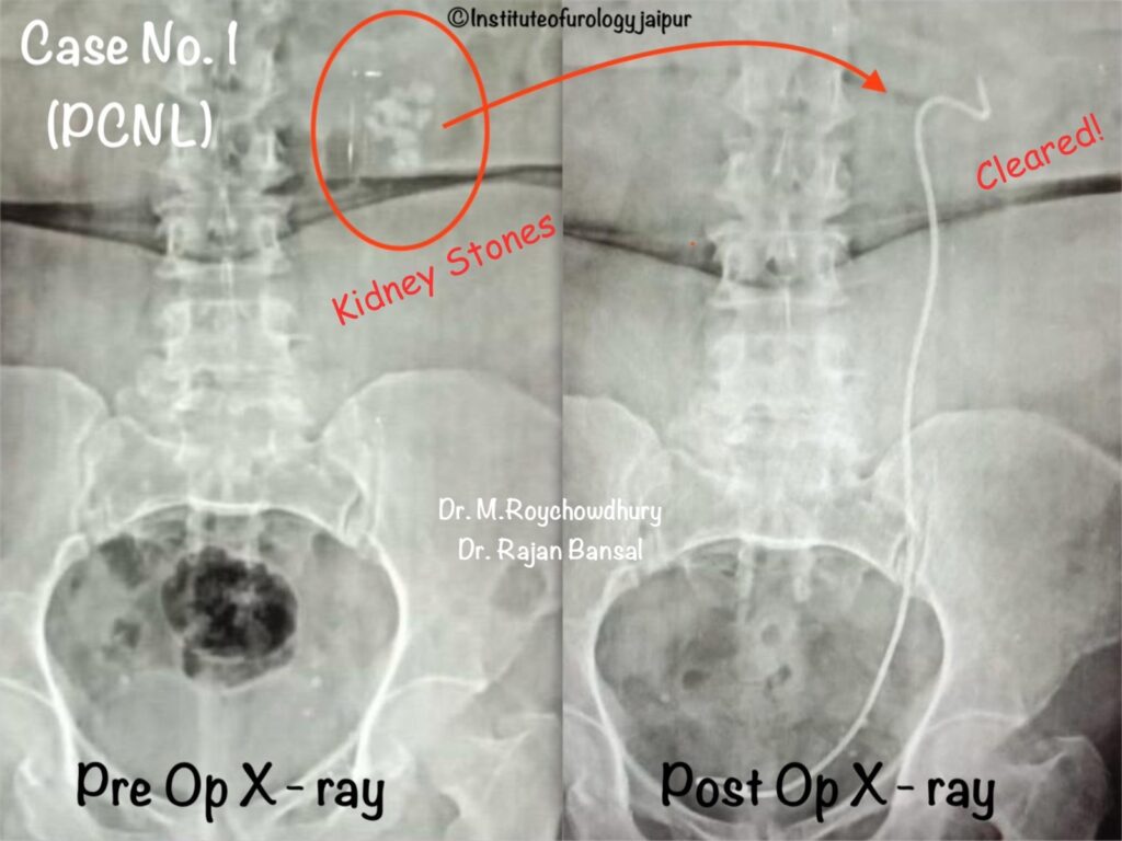 Renal Stone Treatment in Jaipur Dr. M Roychowdhury Dr Rajan Bansal Institute of Urology