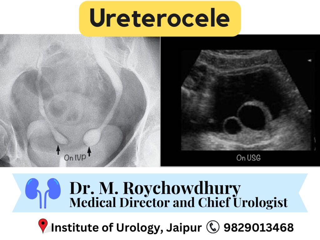 Ureterocele Treatment best doctor in jaipur rajasthan India Dr M Roychowdhury Dr Rajan Bansal