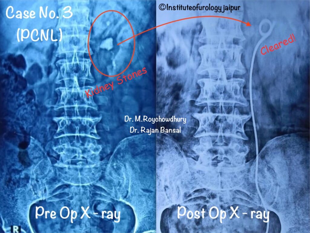 kidney Stone Treatment in Jaipur Dr. M Roychowdhury Dr Rajan Bansal Institute of Urology C Scheme