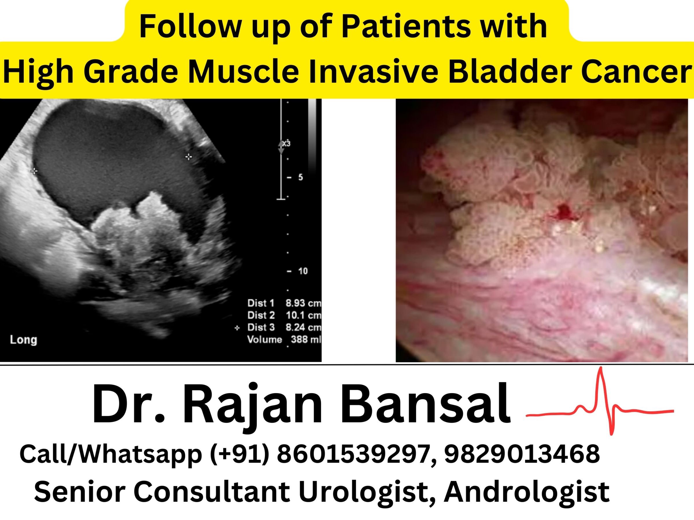High-Grade Non-Muscle Invasive Bladder Cancer Treatment Dr Rajan Bansal Dr M Roychowdhury