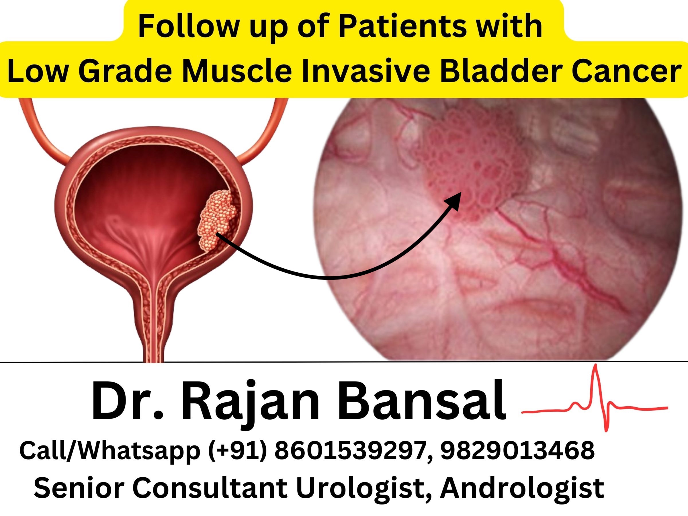 Low-Grade Non-Muscle Invasive Bladder Cancer (NMIBC) Treatment Best Doctor Jaipur Rajasthan Dr. M Roychowdhury Dr. Rajan Bansal