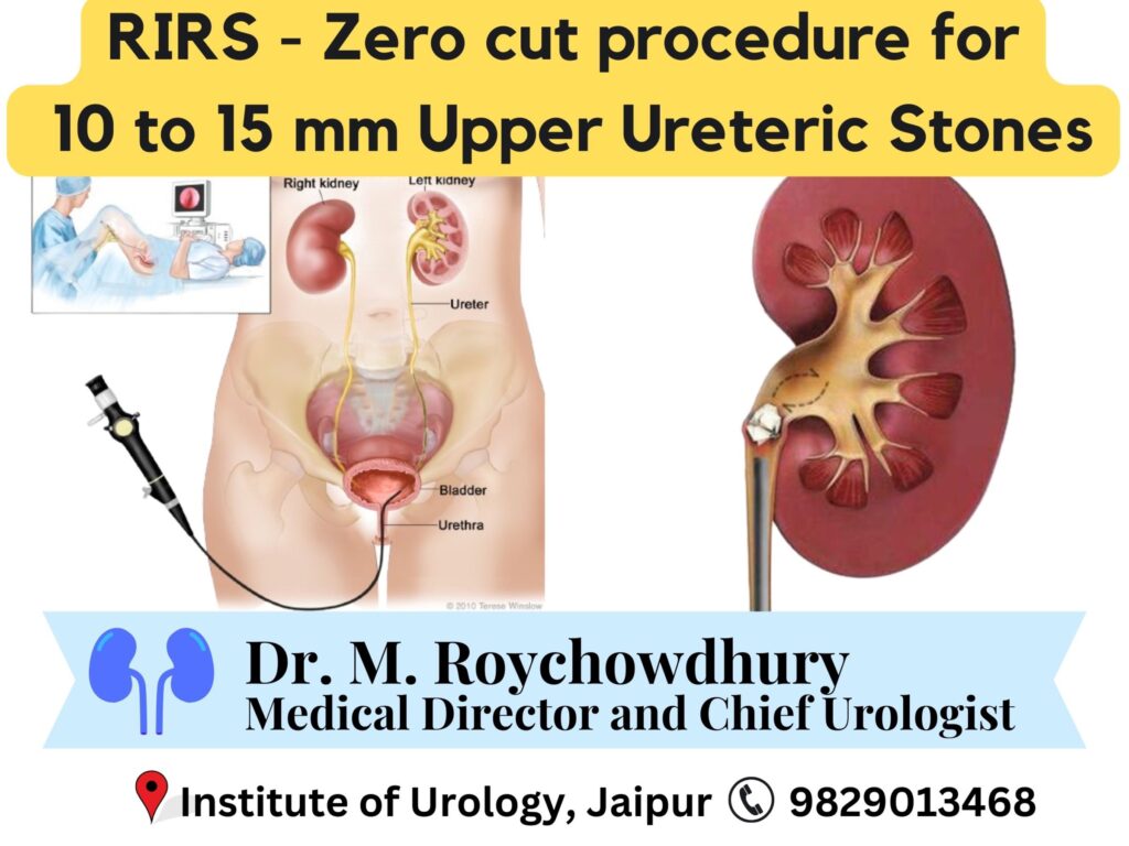 RIRS for 10 to 15 mm Upper Ureteric stone Dr M Roychowdhury Dr Rajan Bansal