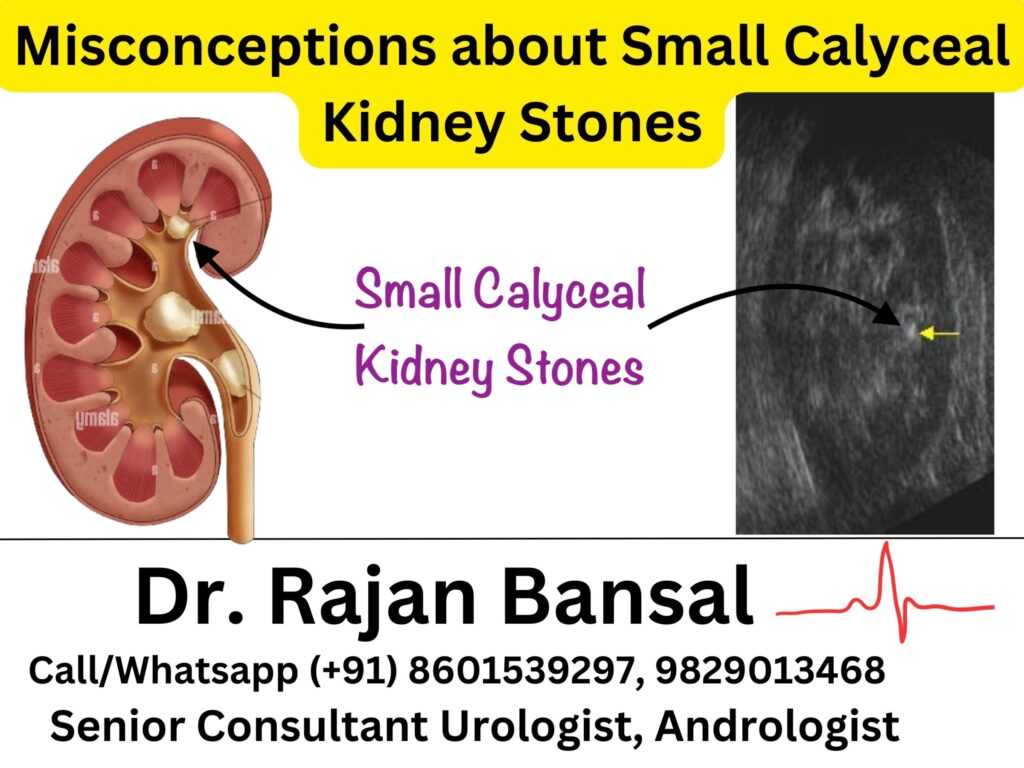 Small Calyceal Renal Stones Treatment Dr. M Roychowdhury Dr. Rajan Bansal C Scheme, Jaipur