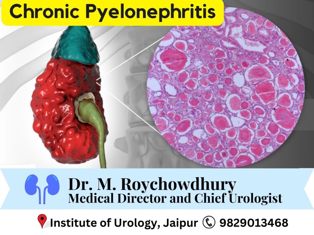 Chronic Pyelonephritis Treatment in Jaipur
