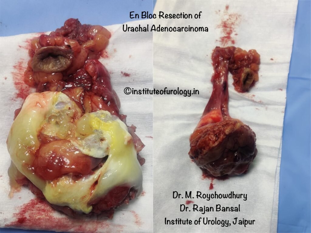 Urachal Adenocarcinoma Treatment at Institute of Urology, Jaipur Dr M Roychowdhury Dr Rajan Bansal