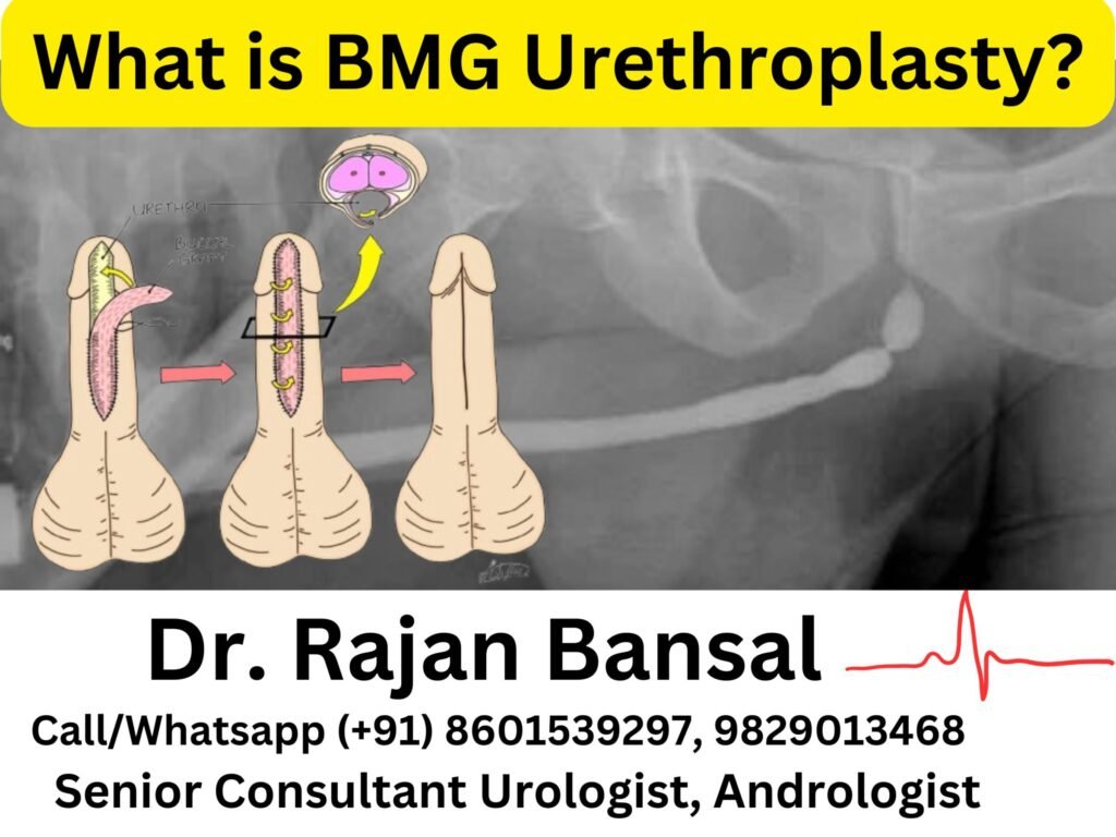 What is BMG Urethroplasty? Dr M Roychowdhury Dr Rajan Bansal