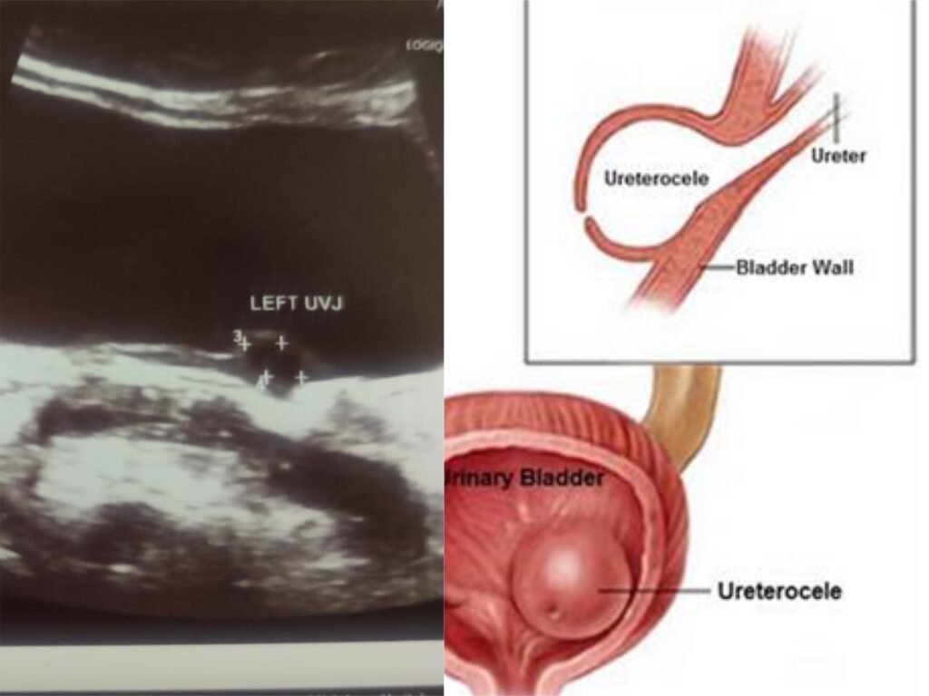 Best Hospital in Jaipur, Rajasthan for Ureterocele and Ureteric Stone Treatment Dr M Roychowdhury Dr Rajan Bansal