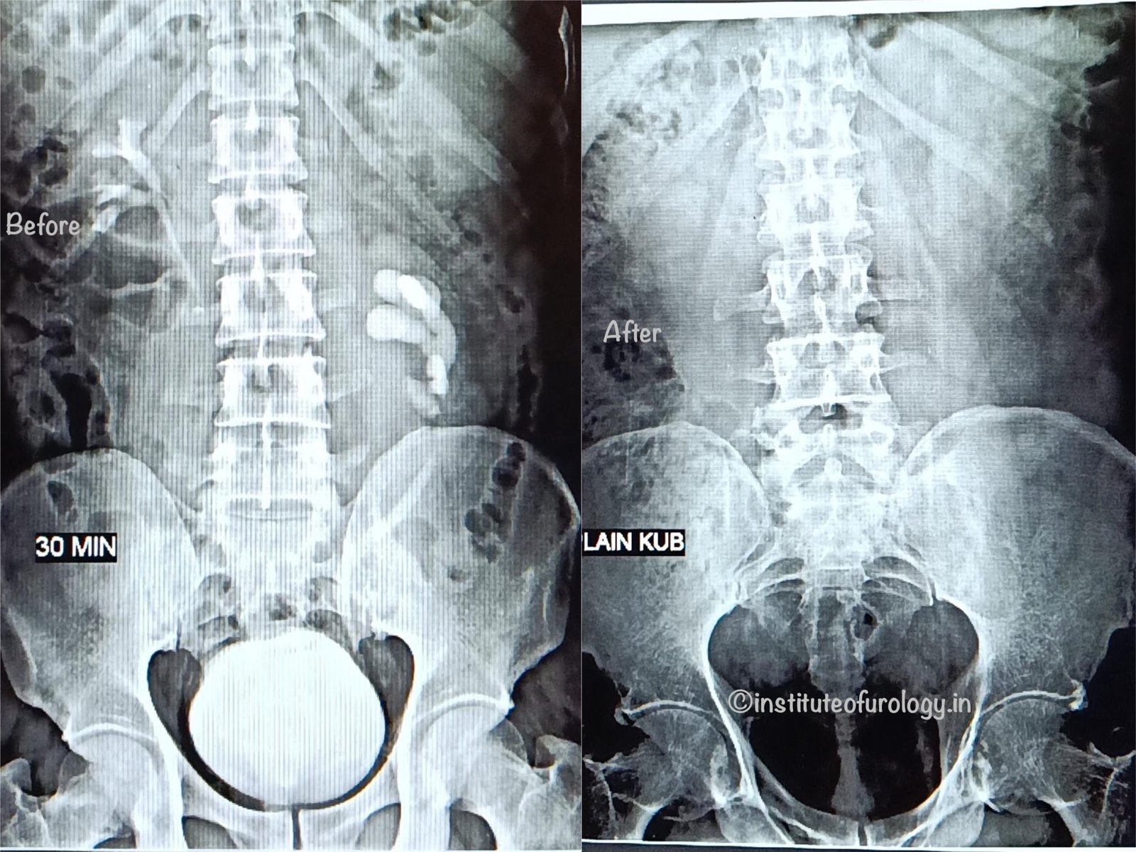 Advanced Stone Removal in Malrotated Kidney – Excellence at Institute of Urology, Jaipur Dr M Roychowdhury Dr Rajan Bansal