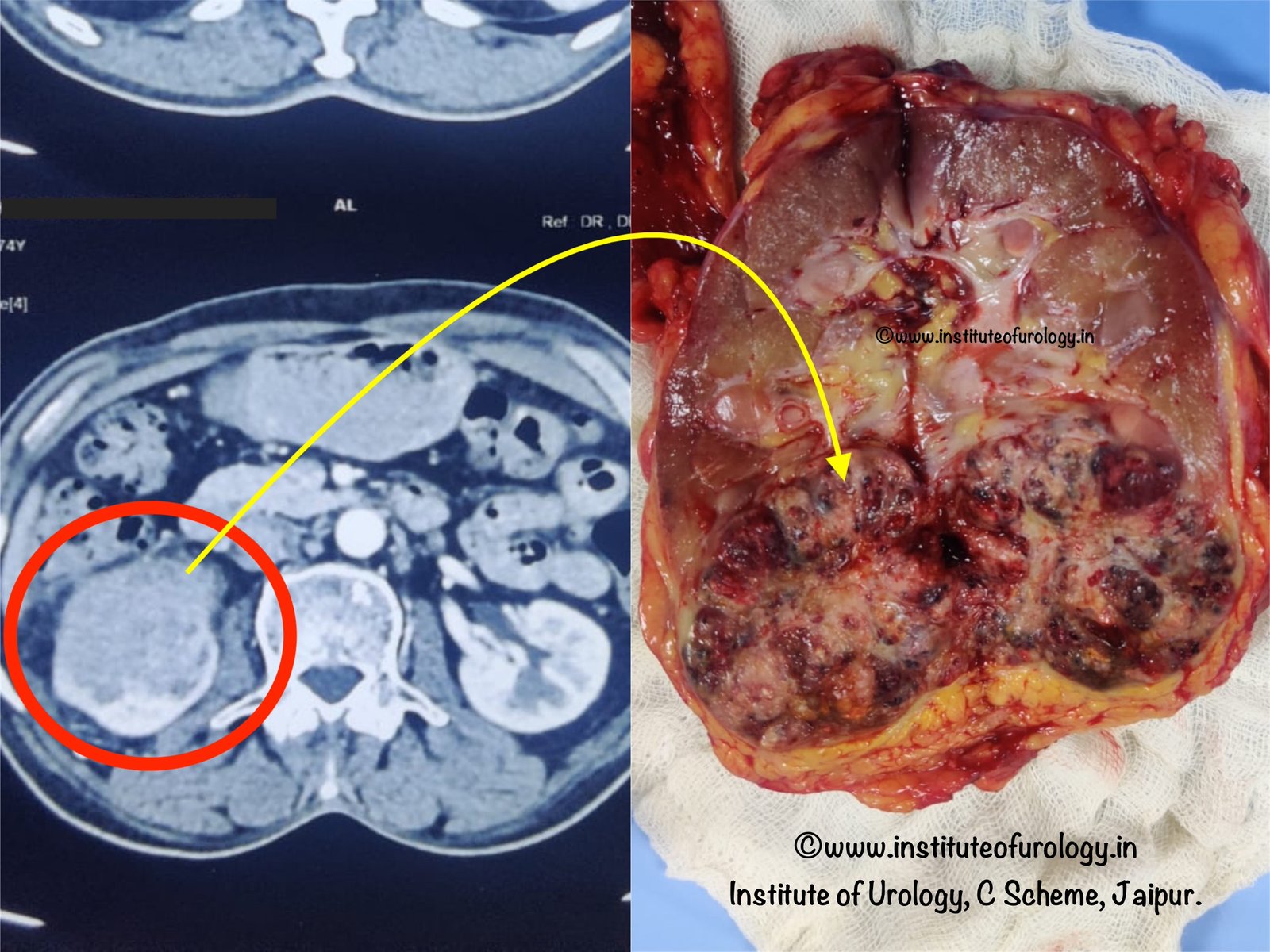 Best Hospital for Treatment of Renal Cancers in Jaipur Dr M Roychowdhury Dr Rajan Bansal
