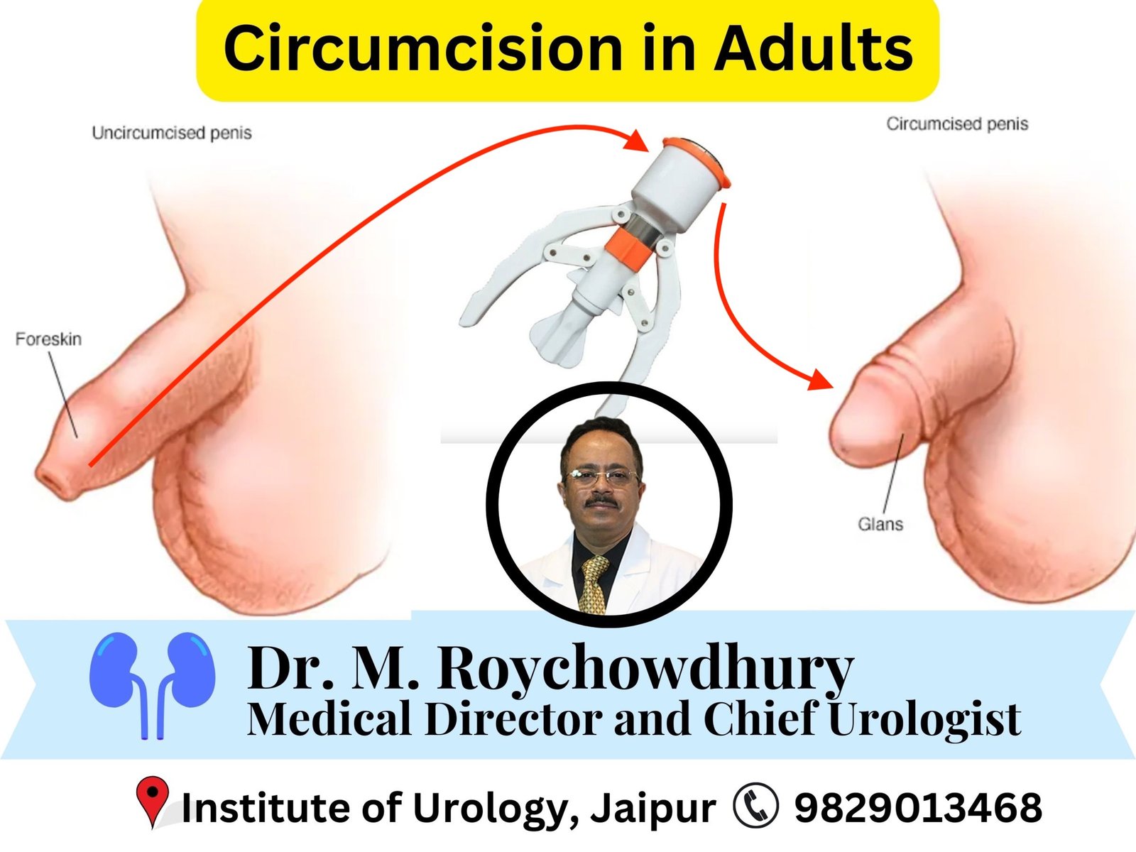 Circumcision in Adults- Medical Benefits, Indications, and Myths Dr M Roychowdhury Dr Rajan Bansal Circumcision in Adults- Medical Benefits, Indications, and Myths Dr M Roychowdhury Dr Rajan Bansal