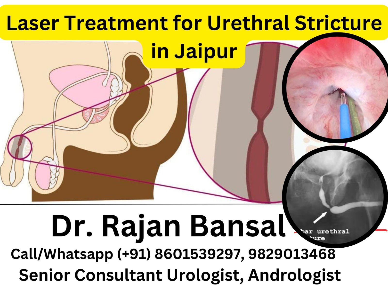 Laser Treatment for Urethral Stricture in Jaipur- The New Era of Precision Urology Dr Rajan Bansal Dr M Roychowdhury