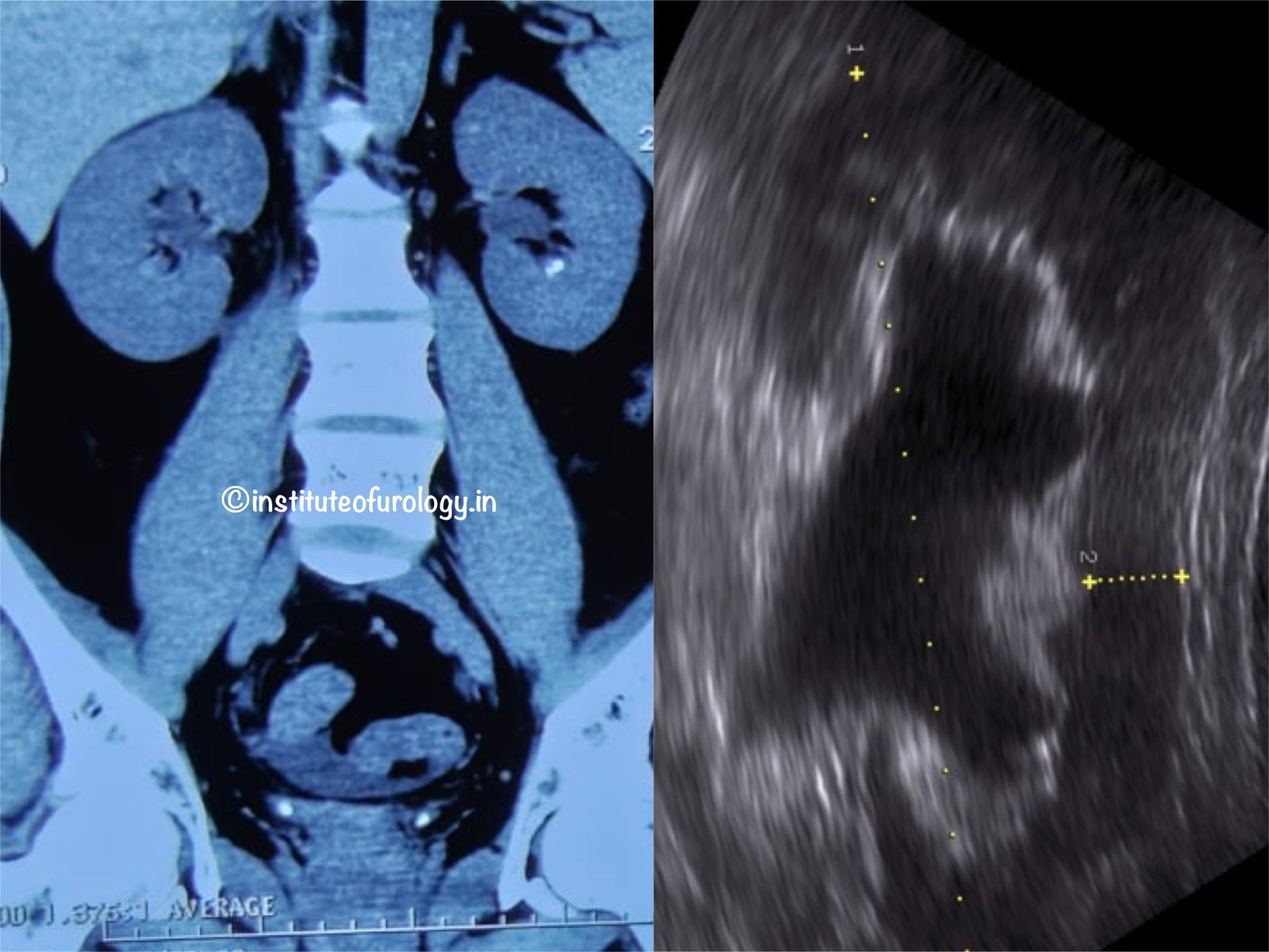 Acute Obstructive Uropathy with AKI in a young patient managed precisely by Institute of Urology, Jaipur