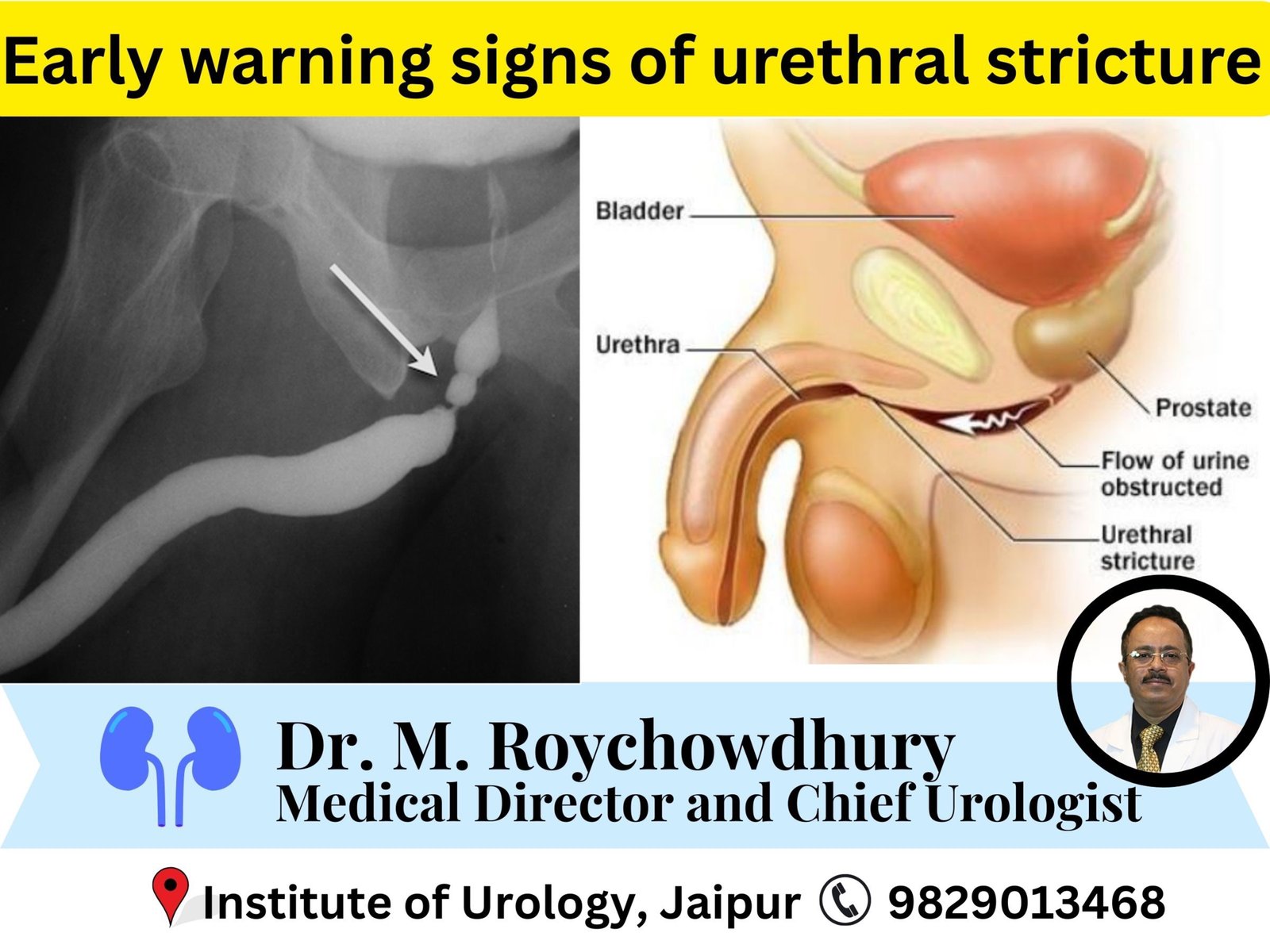Early warning signs of urethral stricture most people ignore dr m roychowdhury dr rajan bansal