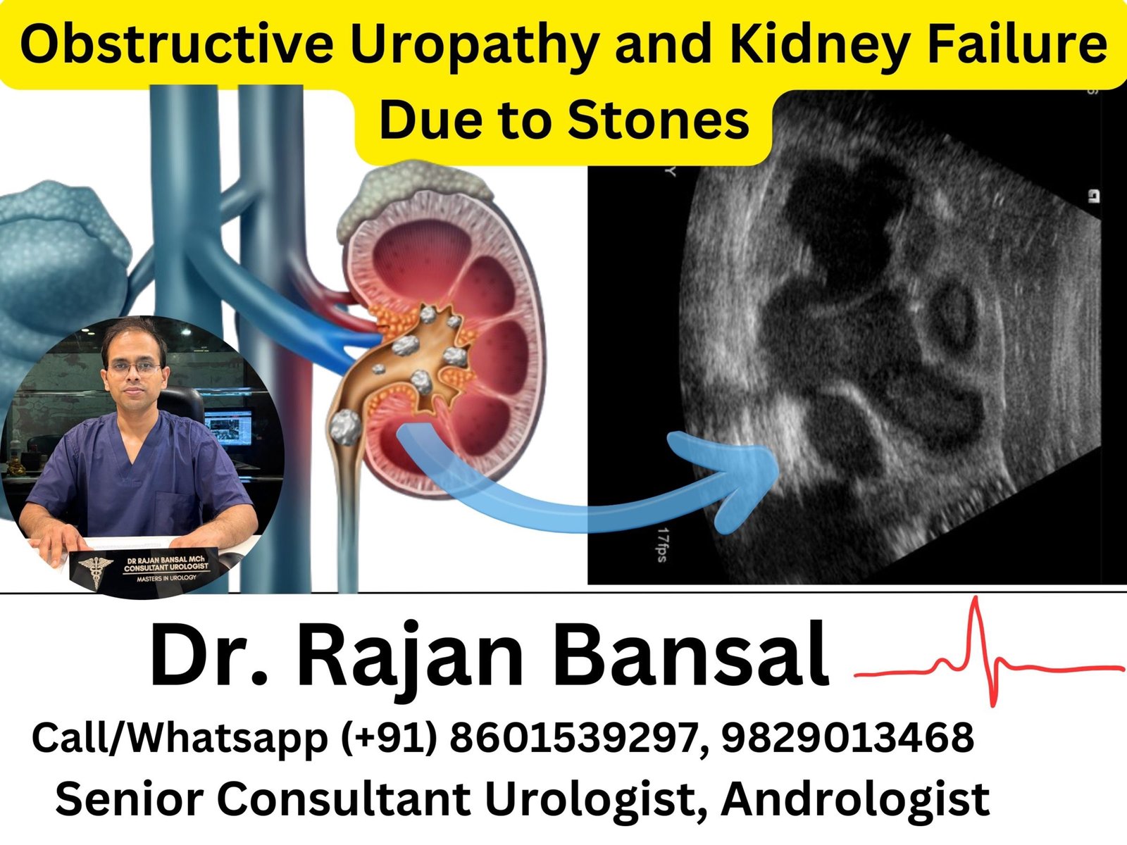 Obstructive Uropathy and Kidney Failure Due to Stones Dr Rajan Bansal Dr M Roychowdhury