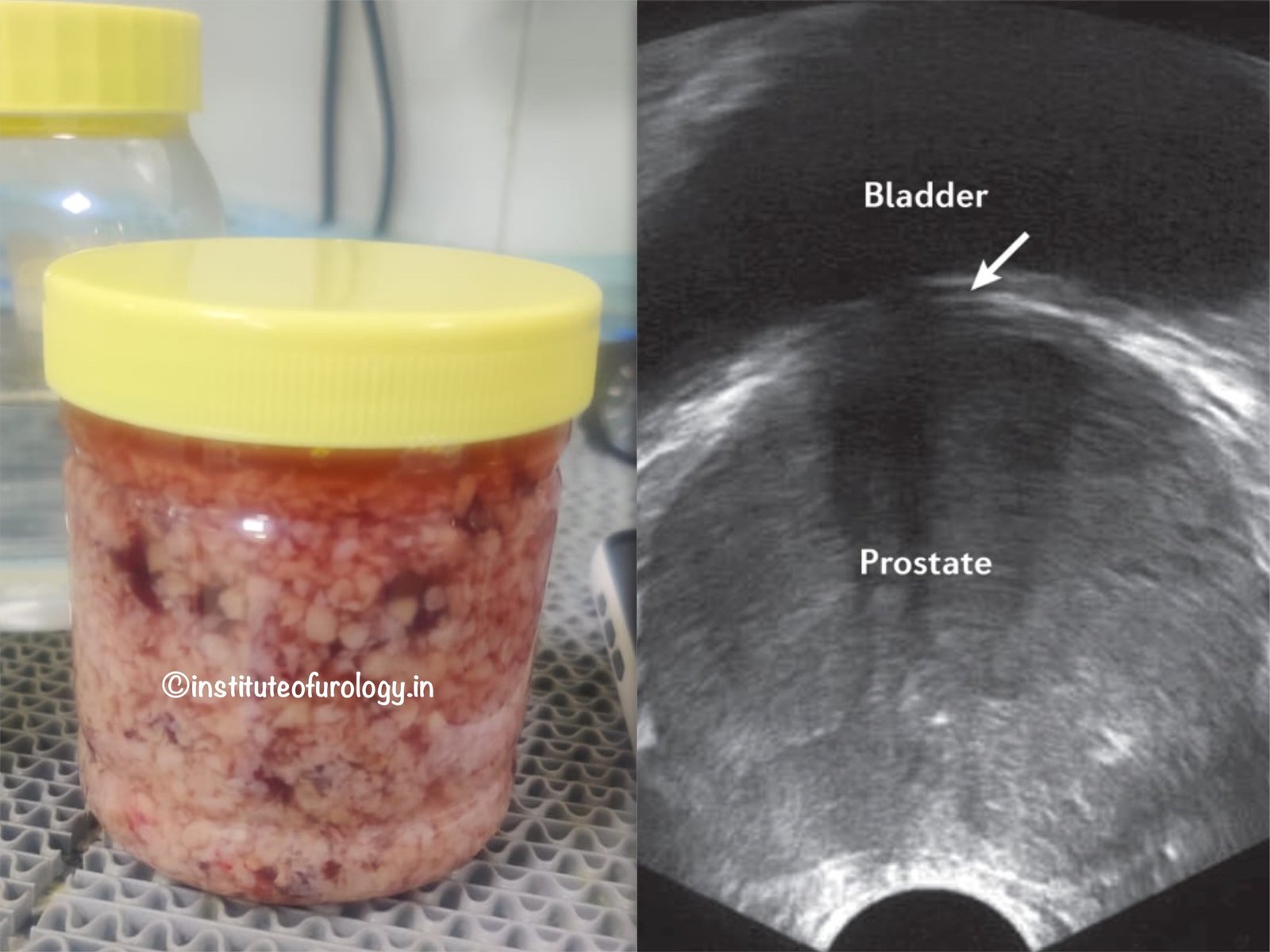 Successful Holmium Laser Enucleation of a 200 g Prostate in a Patient With Long-Standing Obstructive Urinary Symptoms Dr M Roychowdhury Dr Rajan Bansal