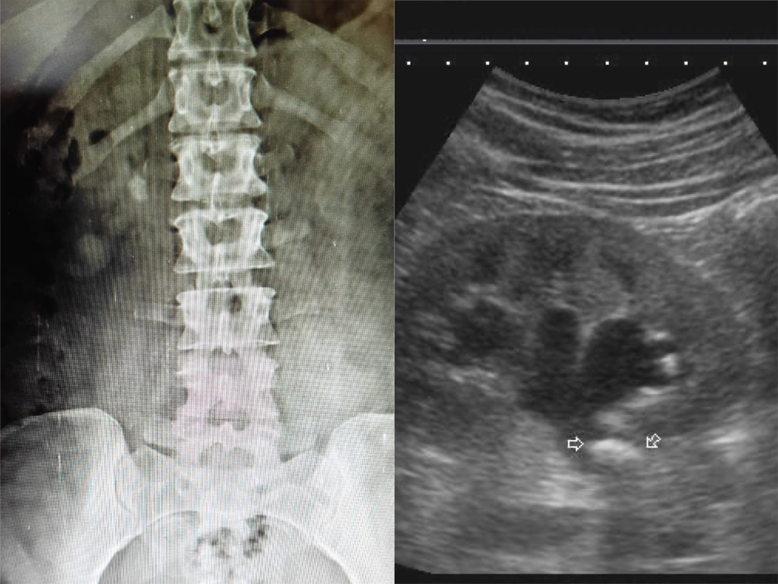 PUJ calculus treatment at Institute of urology, jaipur
