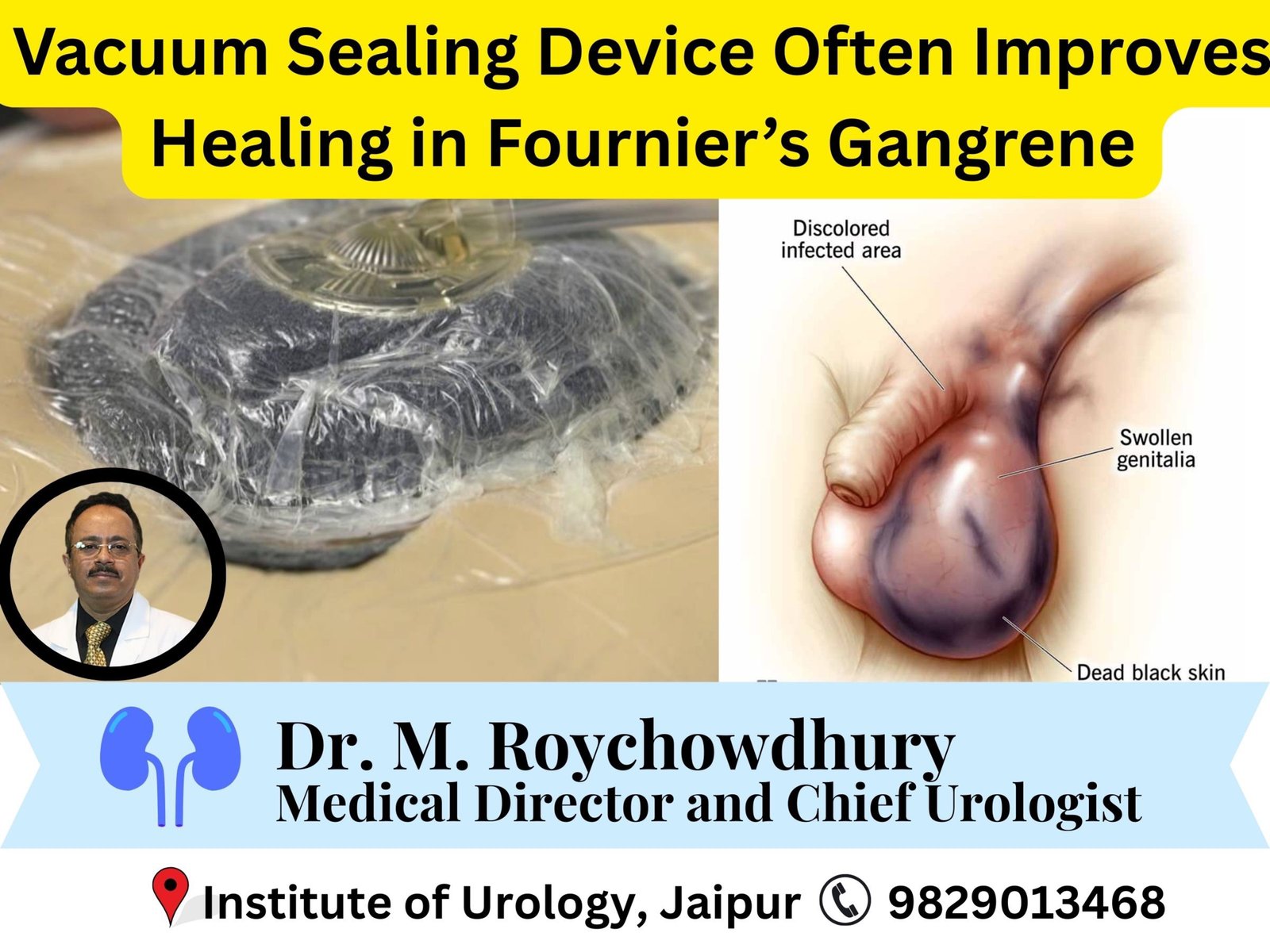 Vacuum Sealing Device Often Improves Healing in Fournier’s Gangrene Dr M Roychowdhury Dr Rajan Bansal