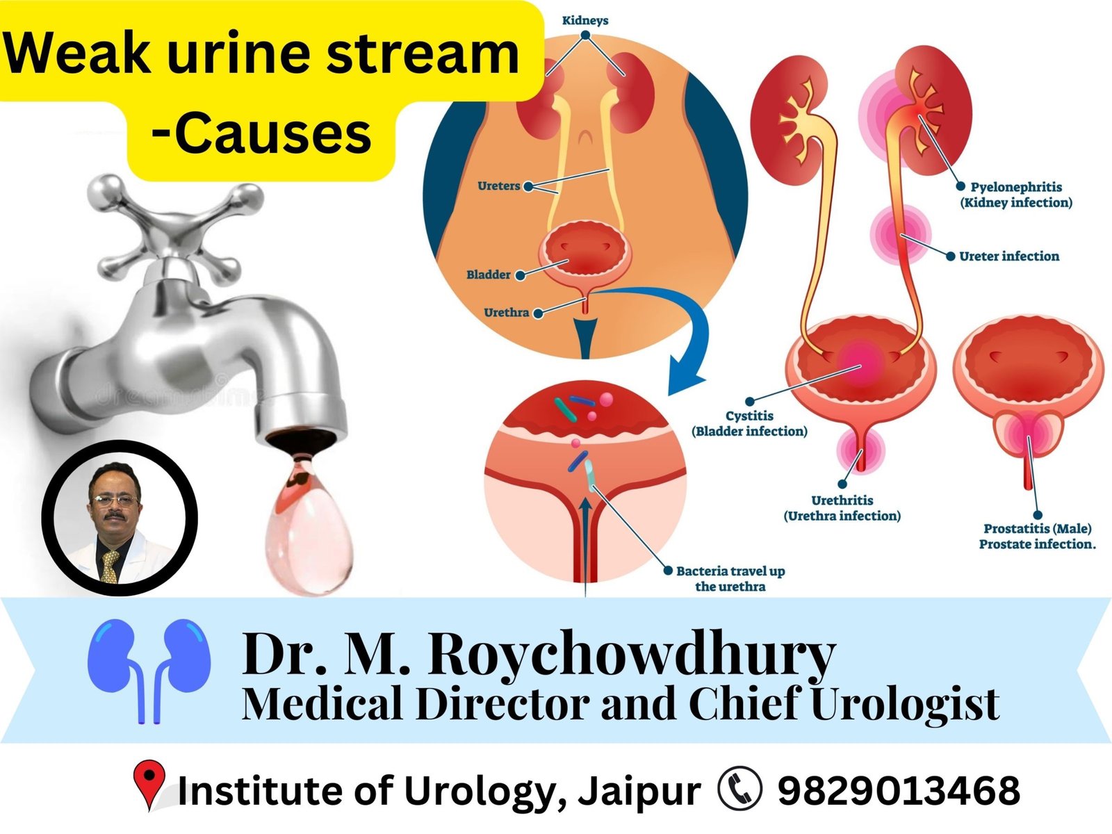 Weak urine stream — causes other than prostate Dr M Roychowdhury Dr Rajan Bansal