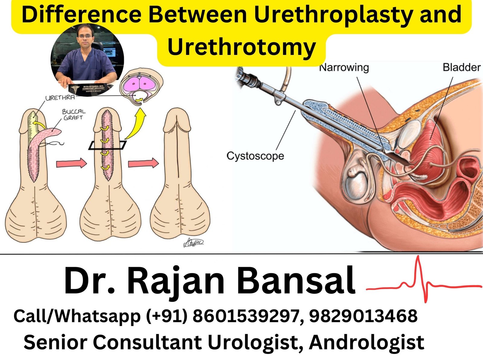 What is the Difference Between Urethroplasty and Urethrotomy?