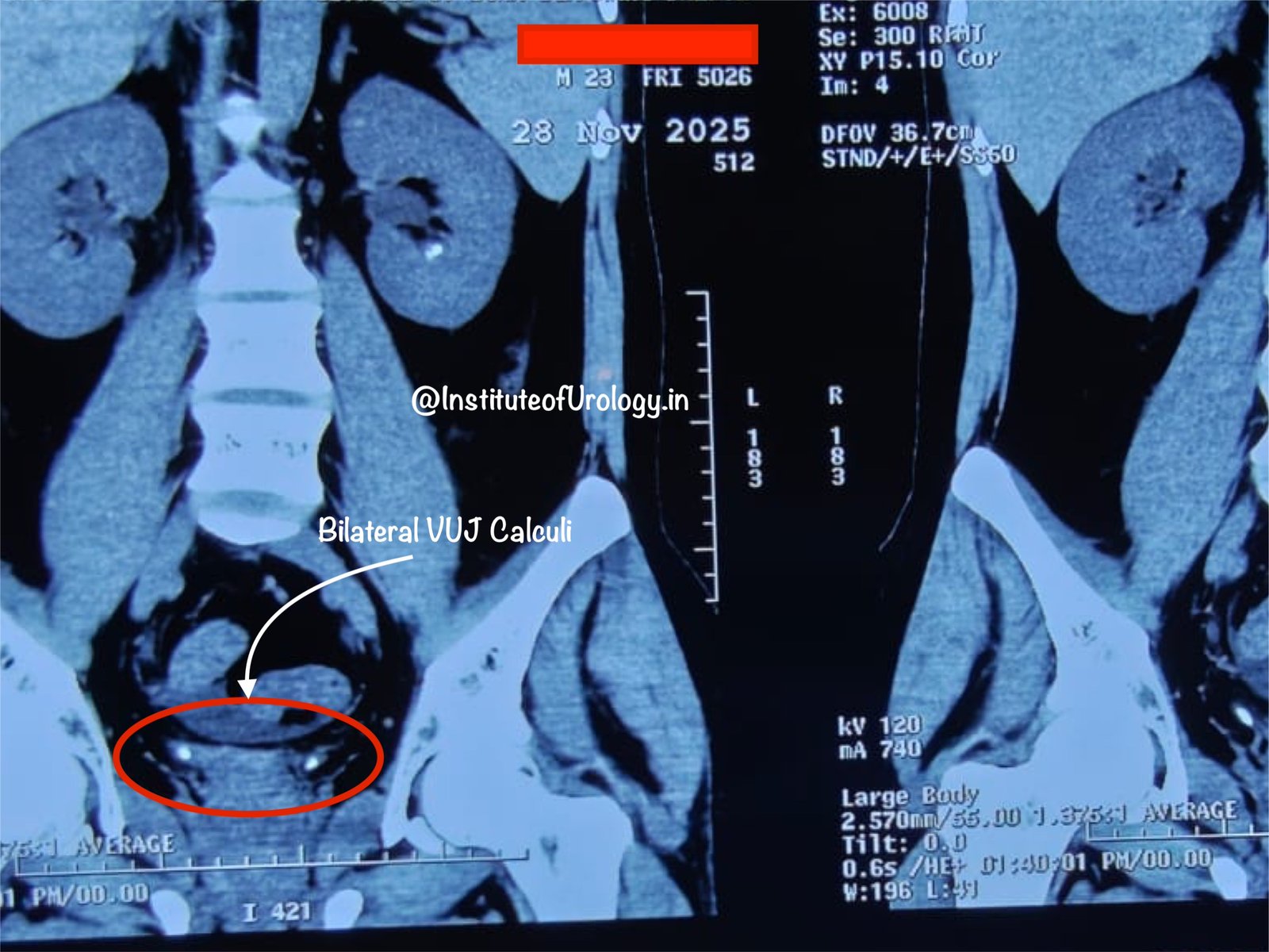 Acute Obstructive Uropathy with Anuria Due to Bilateral VUJ Calculi in a Young Male Dr M Roychowdhury Dr Rajan Bansal