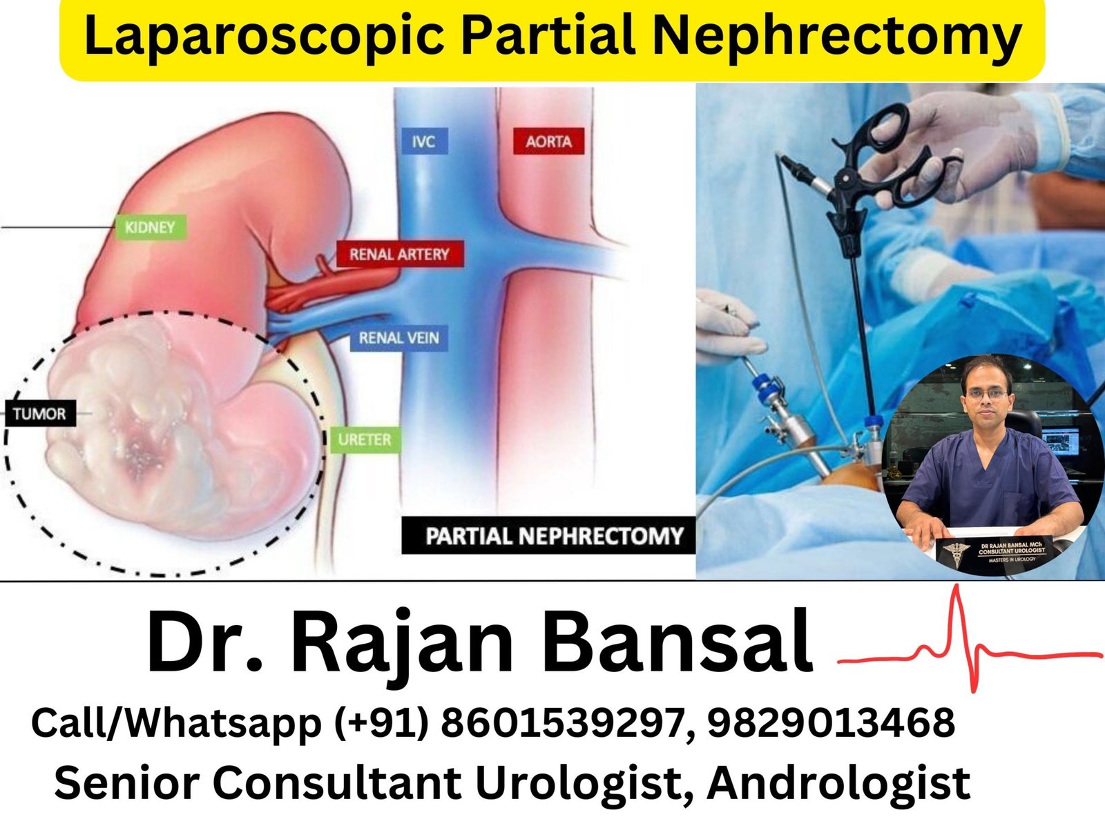 Laparoscopic Partial Nephrectomy- Preserving Renal Function