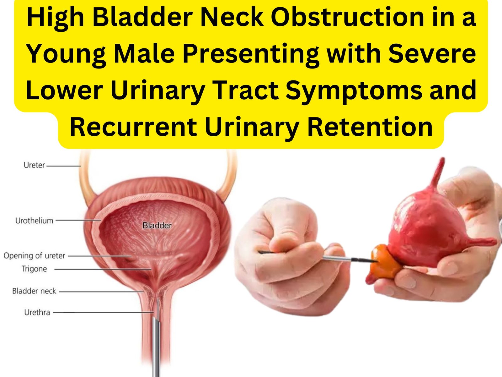 High Bladder Neck Obstruction in a Young Male Presenting with Severe Lower Urinary Tract Symptoms and Recurrent Urinary Retention