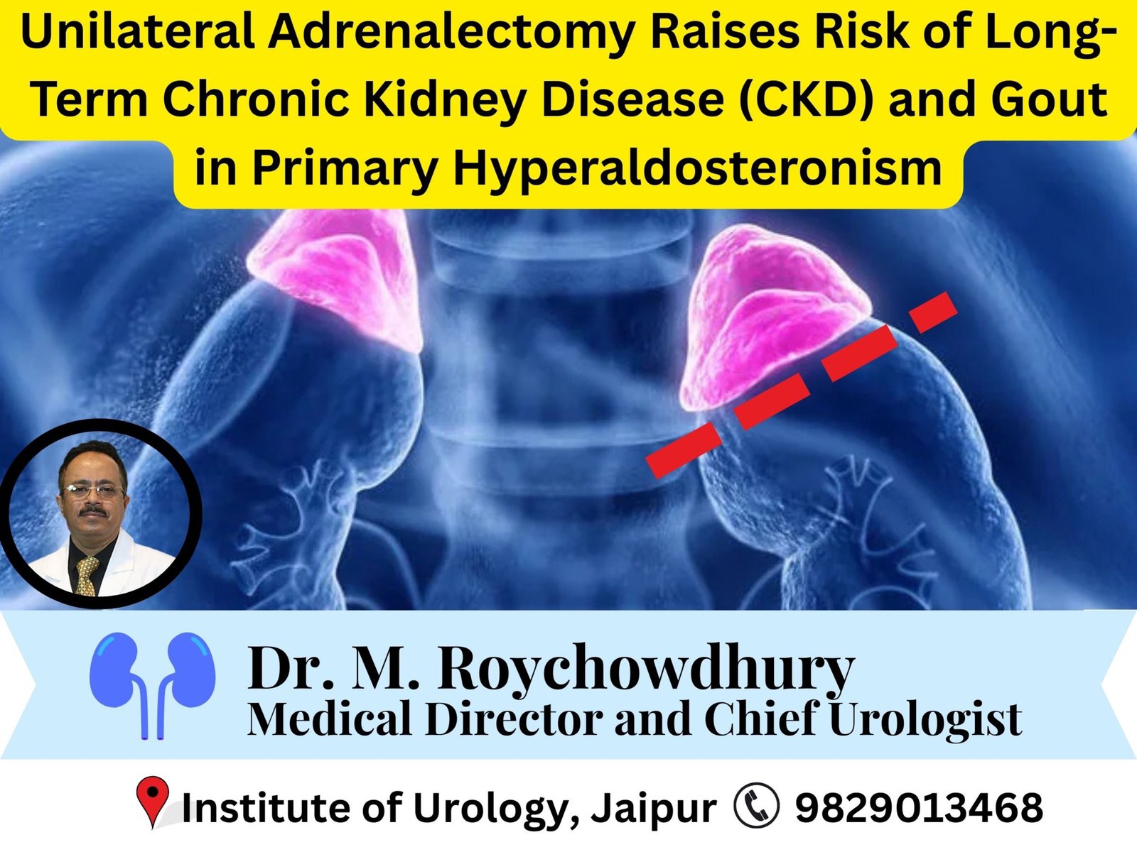 Unilateral Adrenalectomy Raises Risk of Long-Term Chronic Kidney Disease (CKD) and Gout in Primary Hyperaldosteronism dr m roychowdhury dr rajan bansal
