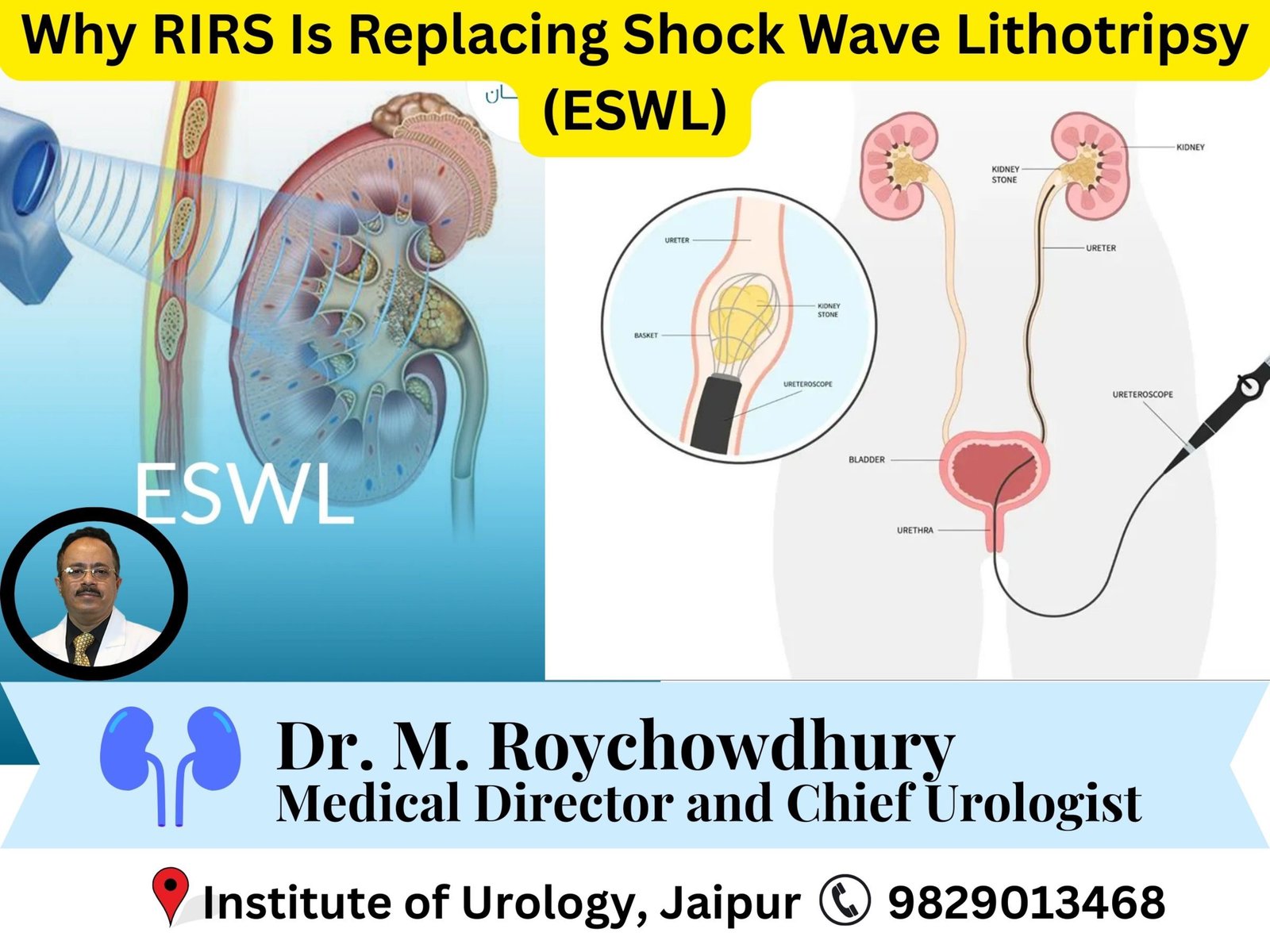 Why RIRS Is Replacing Shock Wave Lithotripsy (ESWL) dr m roychowdhury dr rajan bansal Why RIRS Is Replacing Shock Wave Lithotripsy (ESWL) dr m roychowdhury dr rajan bansal