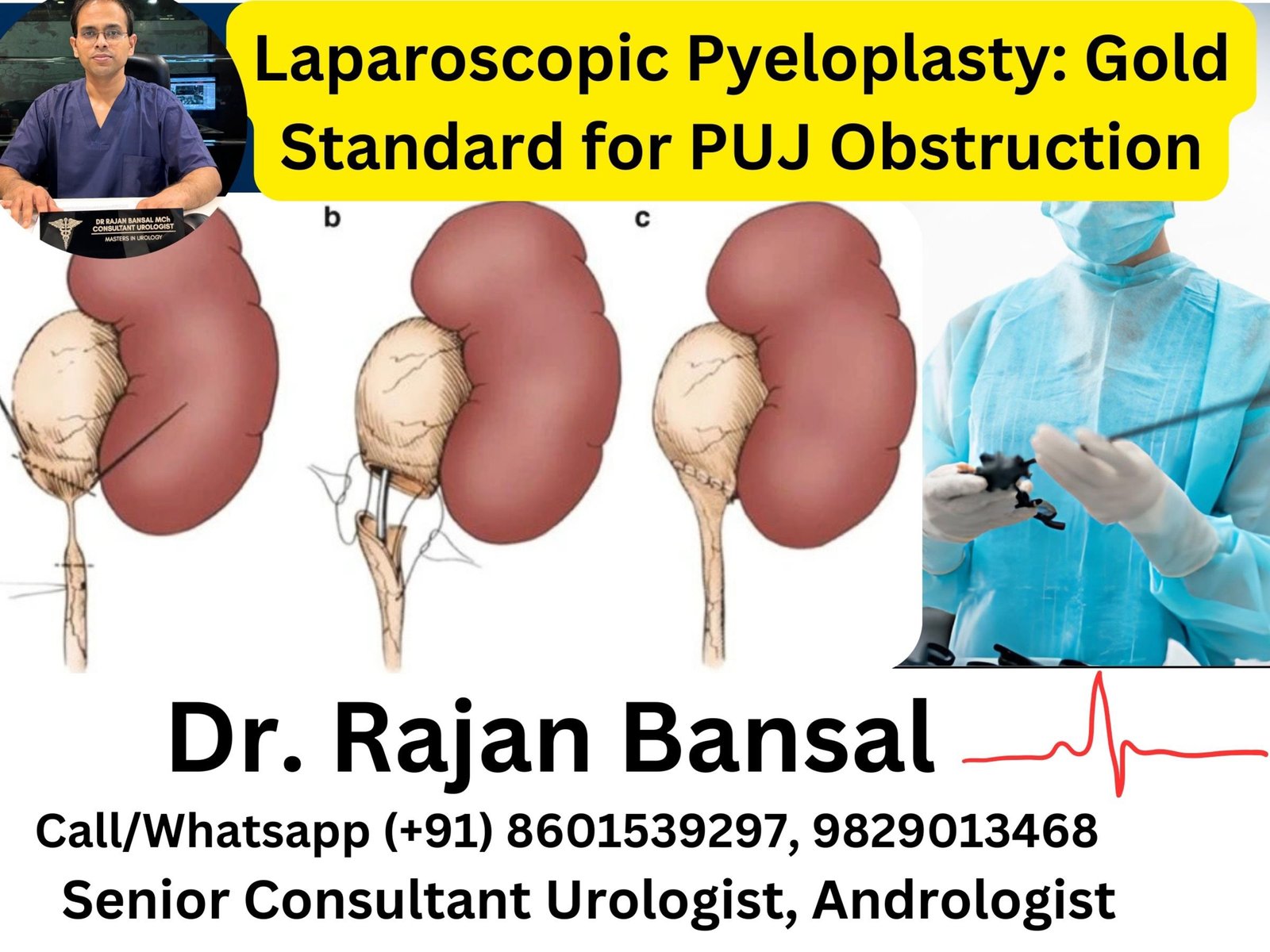 Laparoscopic Pyeloplasty- Gold Standard for PUJ Obstruction Dr Rajan Bansal Dr M Roychowdhury