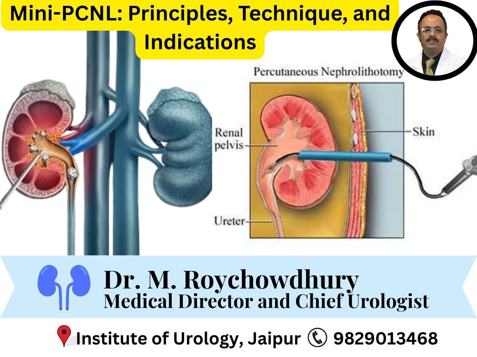 Mini-PCNL- Principles, Technique, and Indications Dr M Roychowdhury Dr Rajan Bansal Mini-PCNL- Principles, Technique, and Indications Dr M Roychowdhury Dr Rajan Bansal