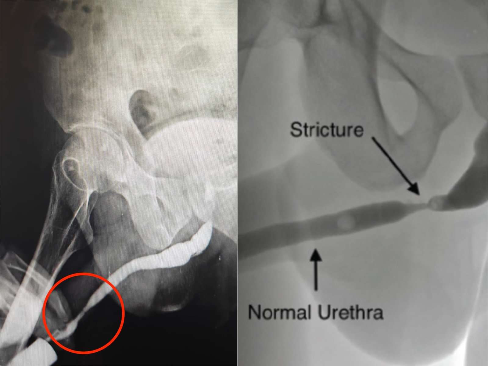 Orandi’s Urethroplasty for Distal Penile Urethral Stricture at Institute of Urology, Jaipur