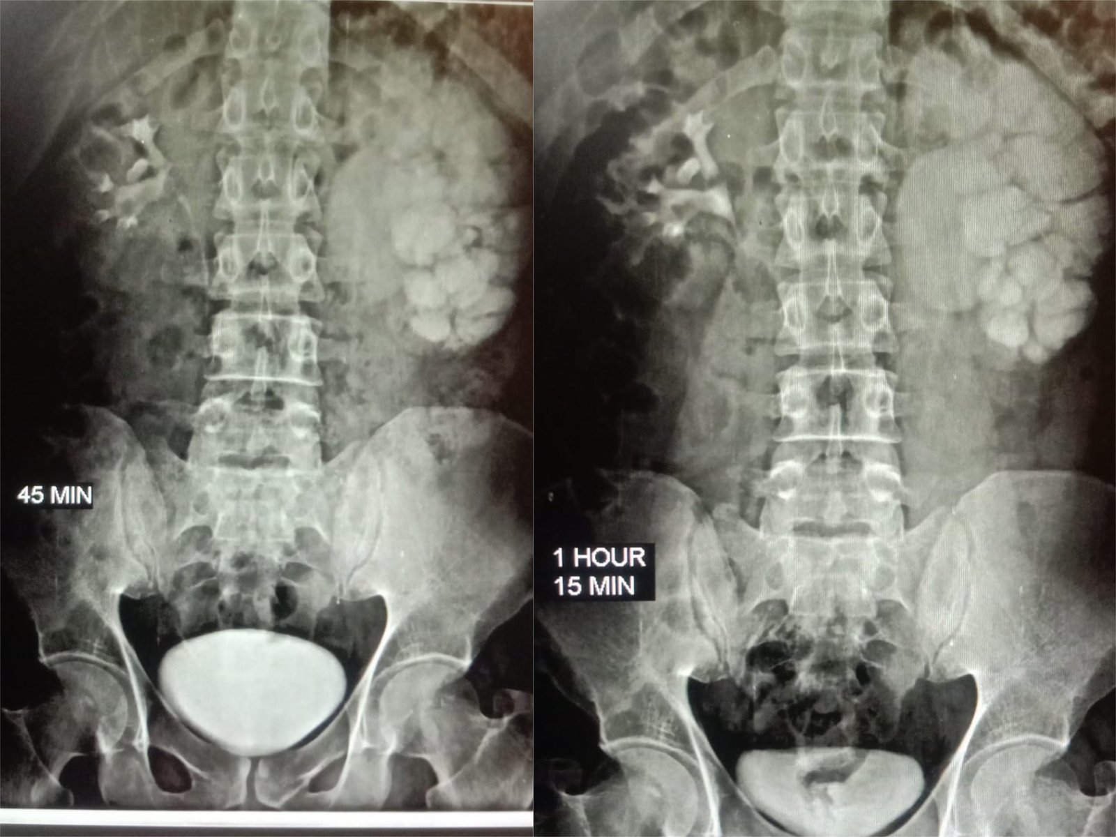 PUJ Obstruction Treatment at Institute of Urology, Jaipur by Laproscopic Pyeloplasty