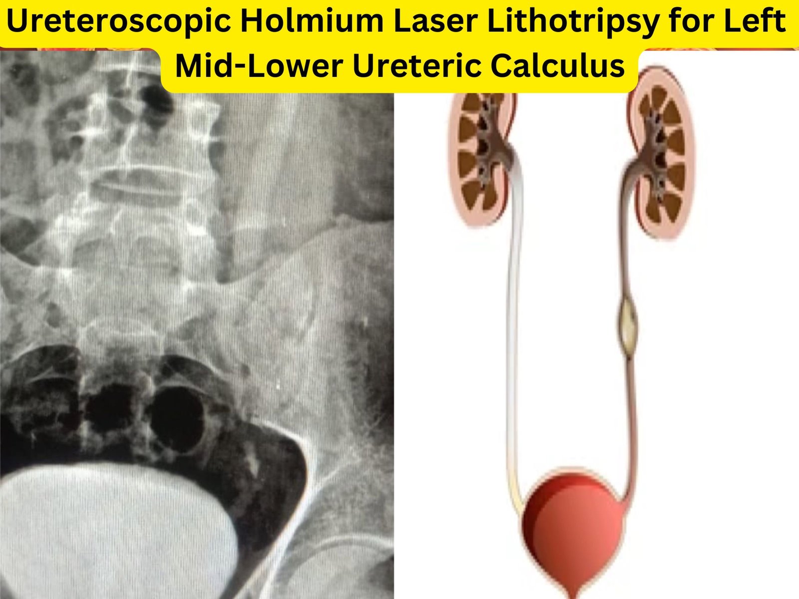 Ureteroscopic Holmium Laser Lithotripsy for Left Mid-Lower Ureteric Calculus Dr rajan bansal dr m roychowdhury