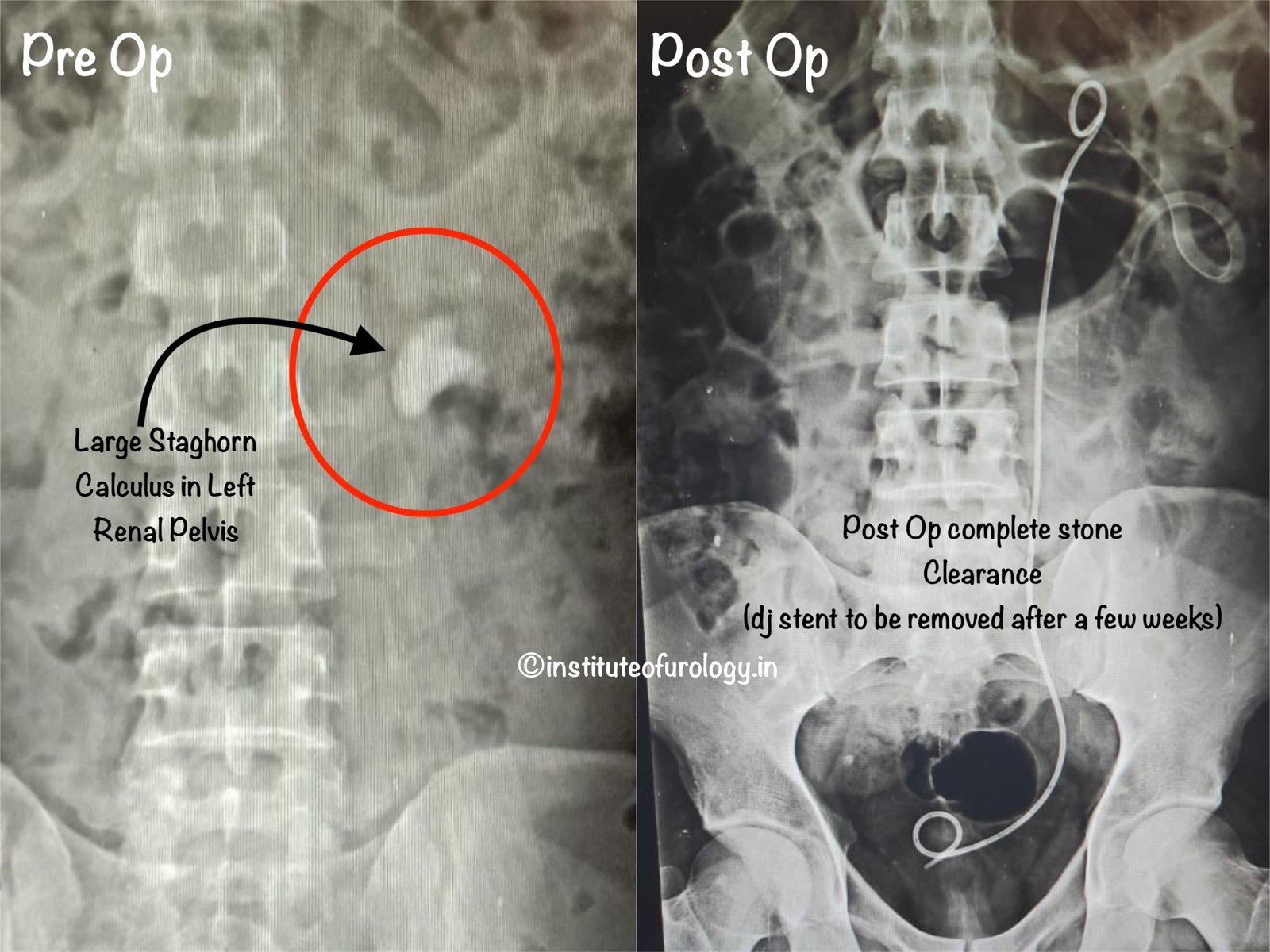 Best Hospital for Large stone surgery PCNL Institute of Urology, Jaipur