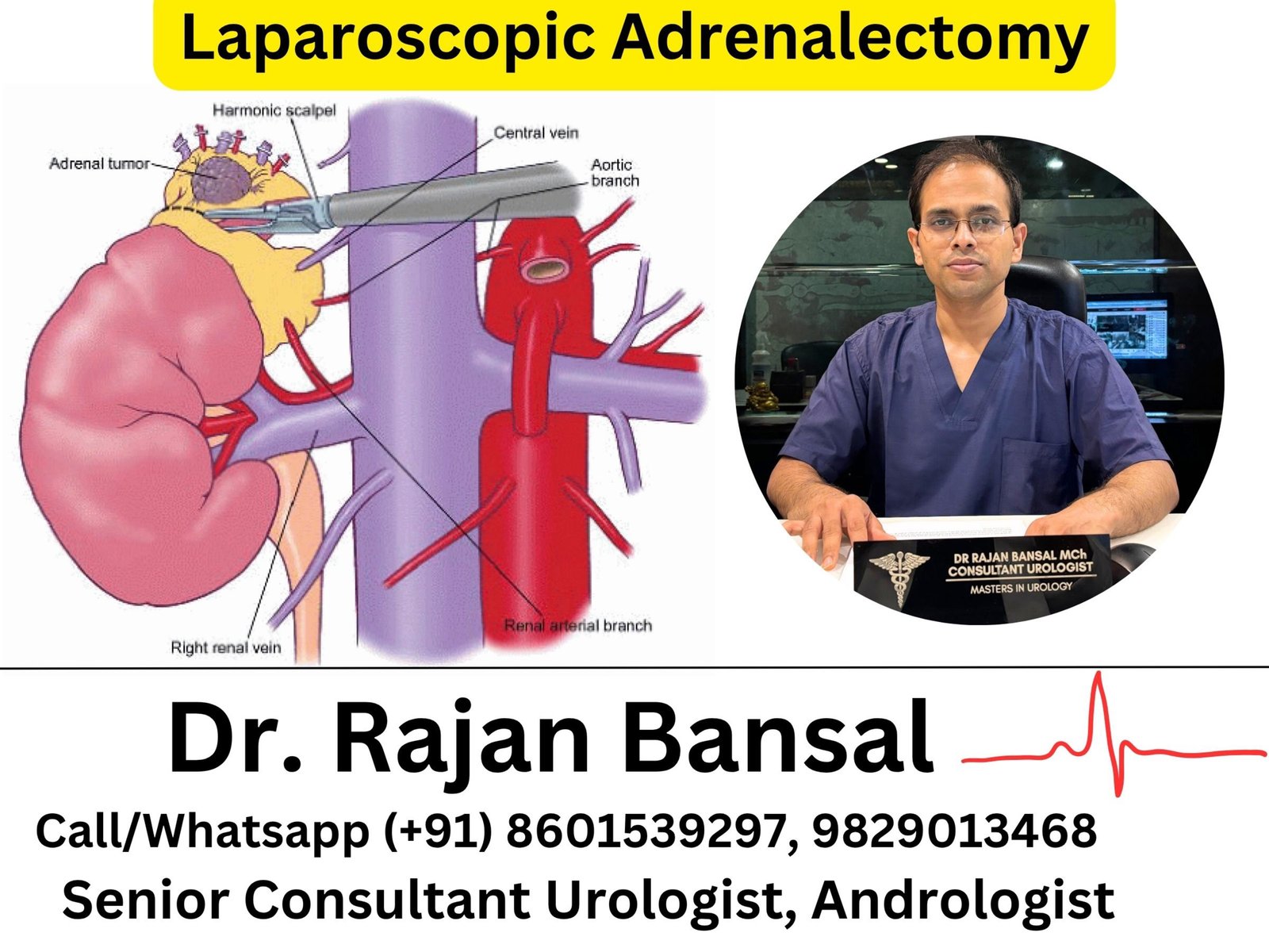Laparoscopic Adrenalectomy Dr Rajan Bansal Dr M Roychowdhury Laparoscopic Adrenalectomy Dr Rajan Bansal Dr M Roychowdhury