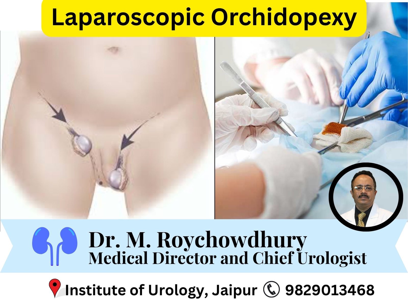 Laparoscopic Orchidopexy Dr M roychowdhury Dr rajan Bansal