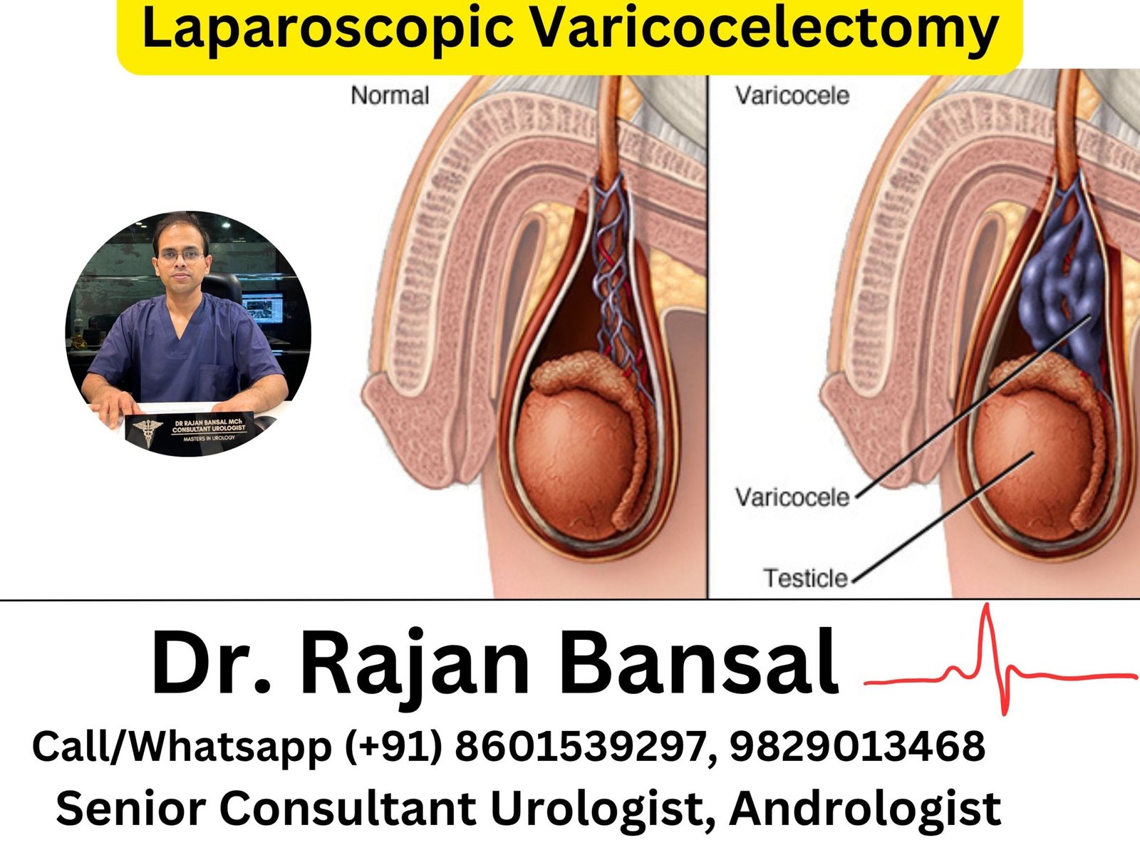 Laparoscopic Varicocelectomy- Principles, Technique, Outcomes and Clinical Significance in Male Infertility.