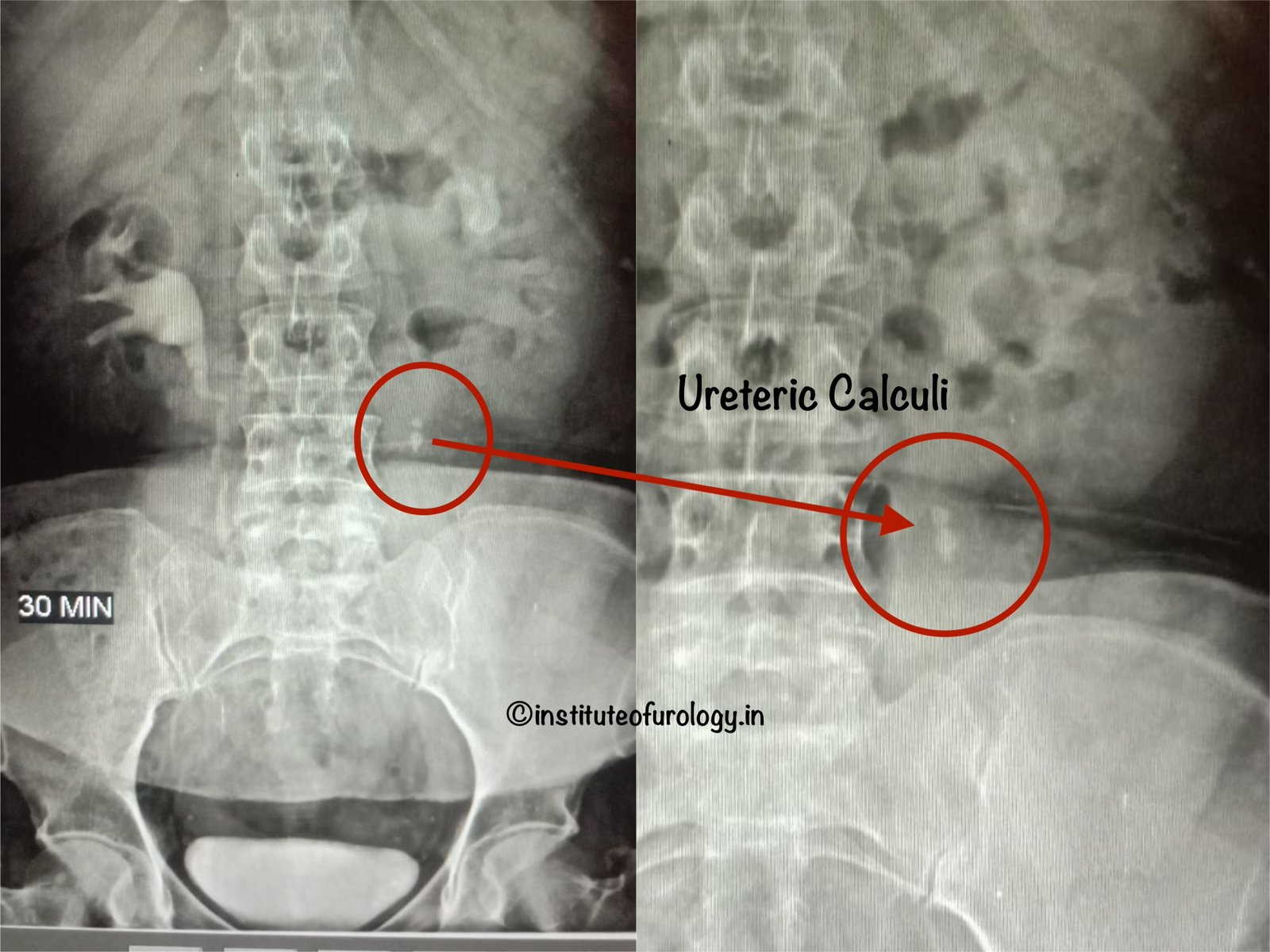 RIRS for Upper Ureteric Calculus with Hydronephrosis