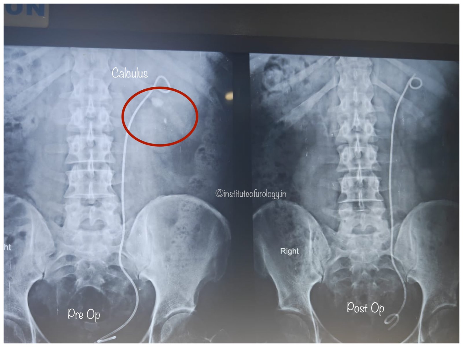 Successful Management of Left Renal Pelvic and Lower Calyceal Calculi Using Flexible Ureteroscopy (RIRS) Following Prior DJ Stenting Successful Management of Left Renal Pelvic and Lower Calyceal Calculi Using Flexible Ureteroscopy (RIRS) Following Prior DJ Stenting