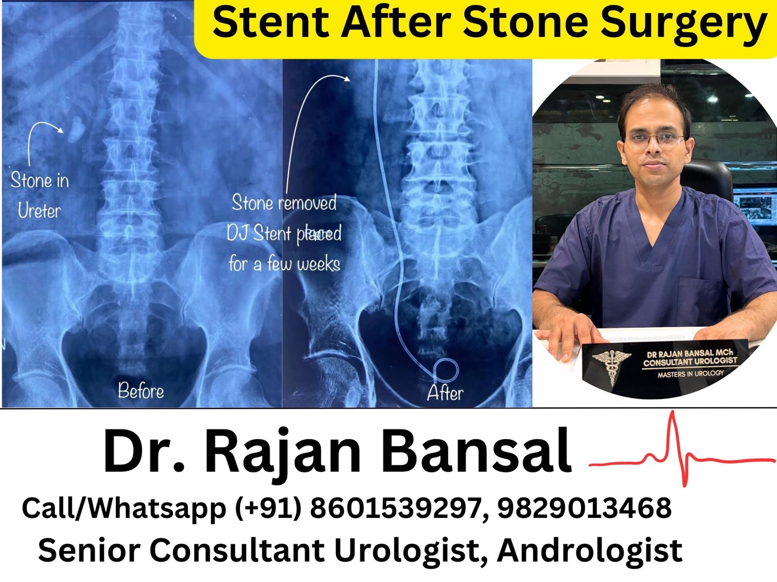 Stent After Stone Surgery- Why It’s Needed & Is It Painful?