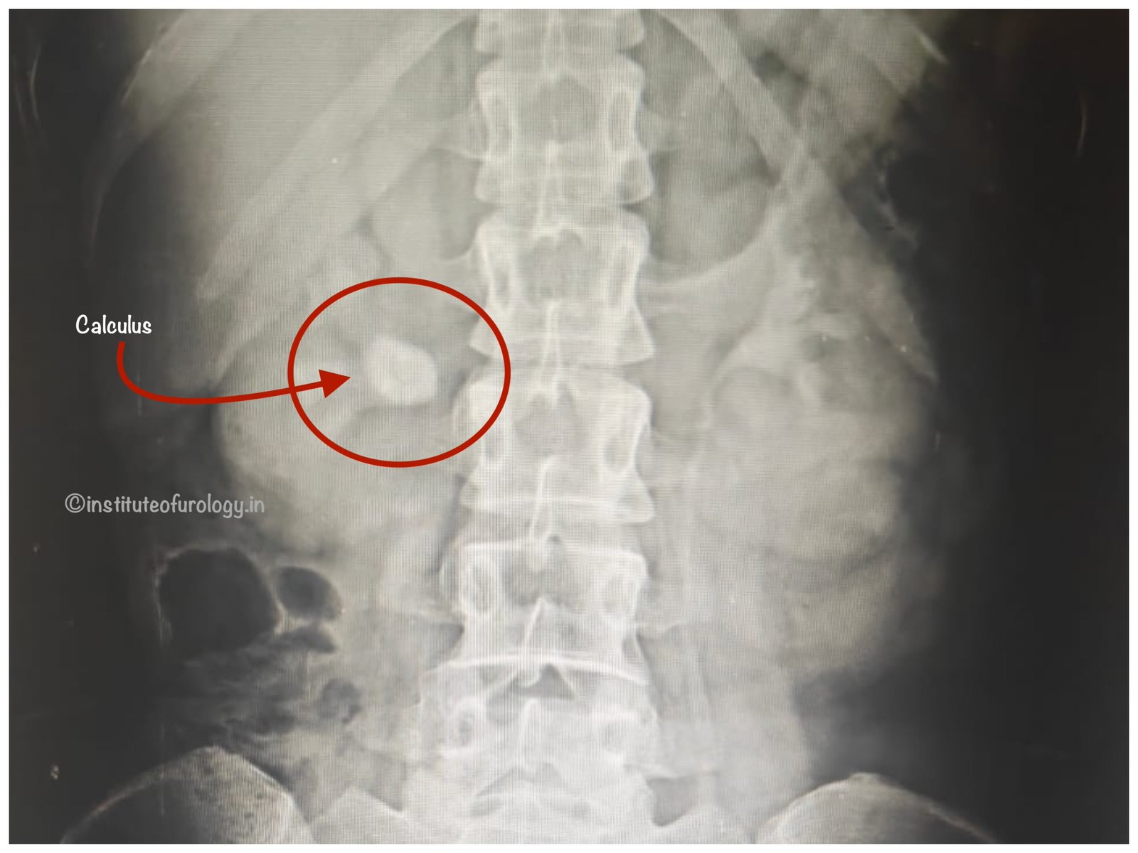 rirs for 20 mm right renal calculus rirs for 20 mm right renal calculus