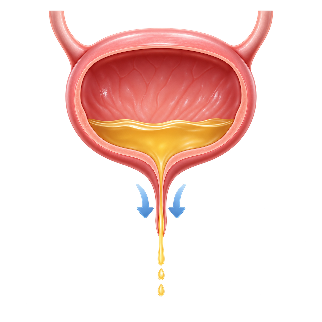Continuous urine leakage through the vagina