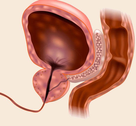 Urethroplasty Surgery Process
