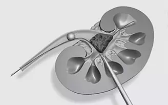 Kidney Stone Management: PCNL / MINIPERC