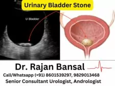 Urinary Bladder Stone Treatment Jaipur Dr Rajan Bansal Urologist C Scheme