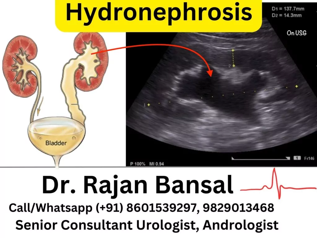 Hydronephrosis Treatment Best Doctor Hospital in Jaipur Rajasthan Dr Rajan Bansal Dr M Roychowdhury