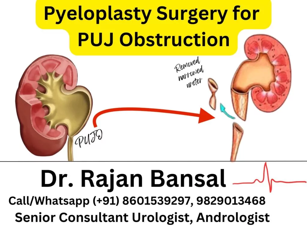 Anderson-Hynes Pyeloplasty Surgery for PUJ Obstruction Dr Rajan Bansal Dr M Roychowdhury Best Urologist in Jaipur Rajasthan