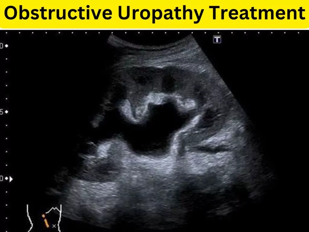 Obstructive Uropathy Treatment at Institute of Urology, Jaipur