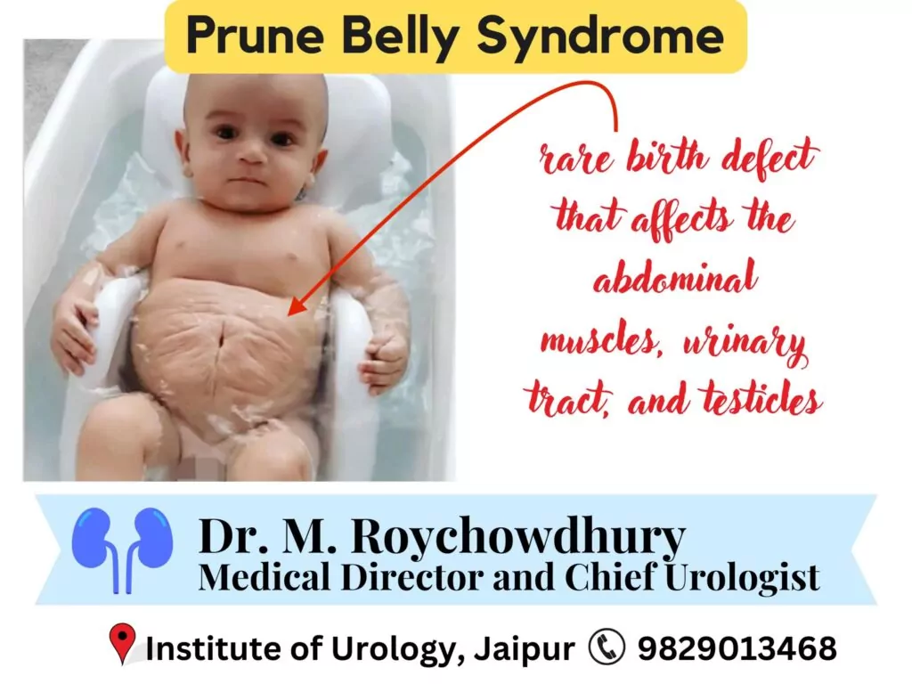 Prune Belly Syndrome- Diagnosis, Management, and Emerging Trends